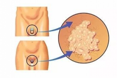 生殖器有白色豆腐渣？-泉州男科医院