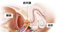 阴茎太敏感了怎么办？-泉州男科医院