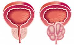 全面了解前列腺-前列腺，别作妖了！-泉州男科医院